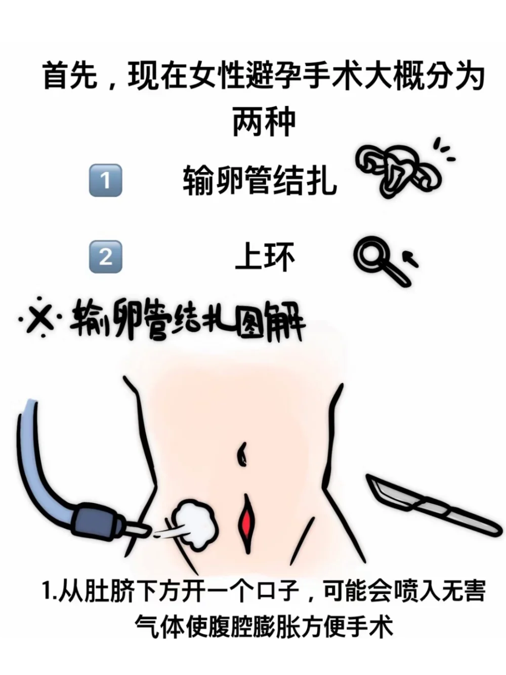 未婚未育的男生，决定做结扎手术